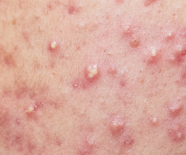 여드름